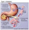 Diabetes Image